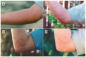 Image result for ant bite