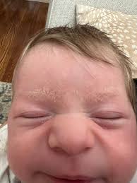 Image result for Cradle Cap