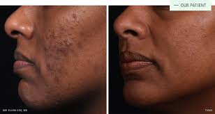 Can everyone get a chemical peel? Chemical Peel Aesthetic Solutions