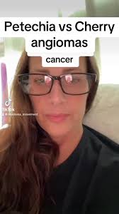 Barbara O Neil Cherry Angioma