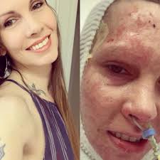 Fundraiser for Alexa Petroff by Barabara Kelly : Alexa's Burn Recovery Fund