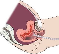 Image result for Uterine Inversion