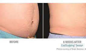 Coolsculpting before and after photos. Coolsculpting Before And After Real Patient Results Sculptology