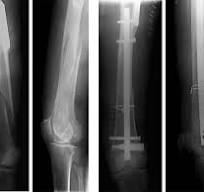 Distal Femoral Nail with Spiral Blade