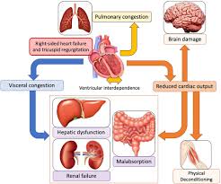 Image result for Right Heart Failure