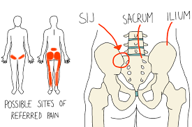 In most cases, there is a confusing pattern of back and pelvic pain that mimic each other, making diagnosis of si joint syndrome sometimes challenging. Si Joint Dysfunction Aptiva Health