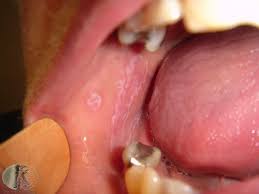 Eine entzündung an der lippe ist nicht zu unterschätzen, weil sie ziemlich weh tun kann. Lichen Planus In Der Mundhohle Deximed