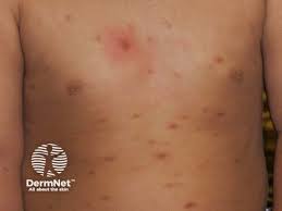 Image result for Urticaria pigmentosa children