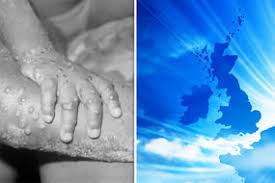 Cases under investigation with one in hospital public health wales confirmed two members of the same household in north wales had developed the virus. Monkeypox Virus What Is It And Is It Contagious Outbreak Fears Grow In Uk Express Co Uk