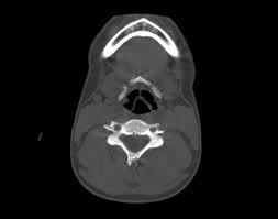 Image result for Hyoid Bone