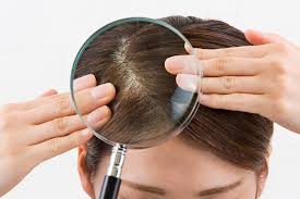 The Only Dandruff Cure You Ll Ever Need Table For Change