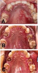Image result for Oral herpes roof of mouth