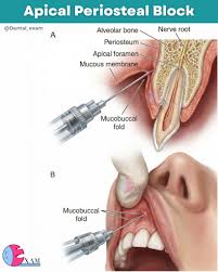 Image result for Periapical Block