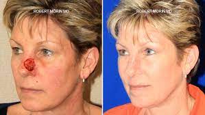 Skin cancer is the most common type of cancer in the united states by a pretty large margin, and it does not discriminate. Skin Cancer Reconstruction Mohs Surgery Nj