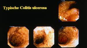 Nicht immer ist das blut im stuhl sichtbar. Todlicher Durchfall Probleme Mit Dem Mikrobiom Bayern 2 Radio Br De