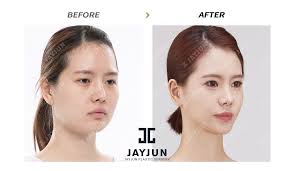 Nose Surgery In Korea Rhinoplasty Revision In South Korea Korea Nose Surgery Korea Nose Revision Korea Nose Job Korea Asain Rhinoplasty Rhinoplasty In Korea Rhi