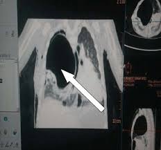 Что такое способ доставки china post registered air mail (cpam)? Ct Scan Coronal Ct Section Of The Chest Showing Ccam Cpam Type 1 Large Download Scientific Diagram