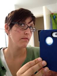 Face-Off: My Jessner Peel Adventure