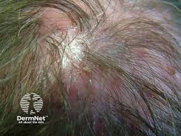 Image result for white scabs on the head in children