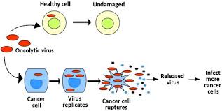Radiation therapy surgery possible treatments include : A Cellular Automata Model Of Oncolytic Virotherapy In Pancreatic Cancer Springerlink