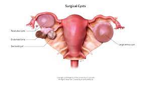 Ovarian cyst issues are not the most positive topic to talk about. Ovarian Cysts In Girls Children S Hospital Colorado