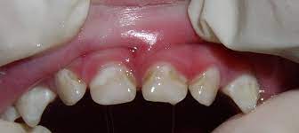Faq Are The Stains On My Child S Teeth Cavities Discovery Pediatric Dentistry