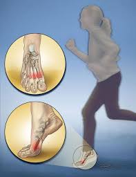Sores, redness, or open wounds near the injured toe. Toe And Forefoot Fractures Orthoinfo Aaos