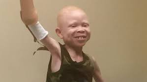 10 stunning photos of black albinos from the #inmyskiniwin campaign, celebrating albino beauty by black girl with long hair • oct 2, 2015 albinism is a congenital disorder that removes pigment from the skin, hair and eyes. Tanzanian Children With Albinism Hunted For Their Body Parts Receive Prosthetic Limbs And A New Lease On Life Abc News