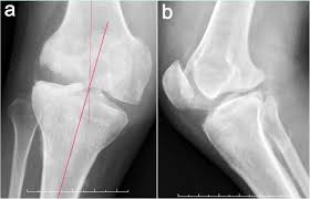 Symptoms may include the following: Charcot Neuroarthropathy Of The Knee Due To Idiopathic Sensory Peripheral Neuropathy Bmc Musculoskeletal Disorders Full Text