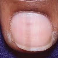 Image result for Acral lentiginous melanoma nail