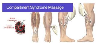 Image result for Compartment Syndrome