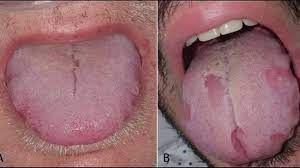 En caso de tener síntomas (fiebre o tos o dificultad respiratoria), sigue estos. La Lengua Covid Un Nuevo Sintoma Descubierto En Madrid Para Detectar La Enfermedad