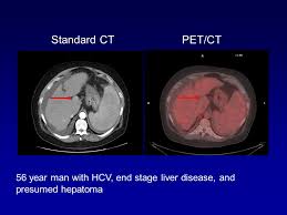 Pet (positron emission tomography) and ct (computed tomography) are both important diagnostic tools used to determine the presence and severity of cancers, neurological conditions and cardiovascular disease, as well as to determine how well cancer is responding to therapy. Pet Ct In Oncology George Segall M D Stanford University Ppt Video Online Download