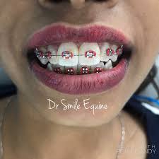1st dental clinic has been in operation for more than 10 years, serving the good residents of bukit jelutong and shah alam in. Braces Deposit Klinik Pergigian Dr Smile Taman Equine Facebook