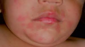 Fricker m, helbling a, schwartz l, muller u. Anaphylaxis Diseases And Conditions Pediatric Oncall