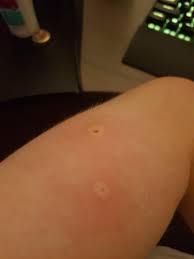 So they can sting more than once. Bumblebee Stings Beekeeping