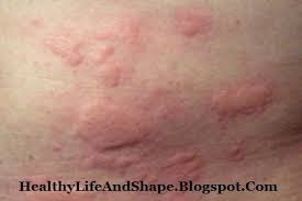 Home Remedies For Red Rashes And Itchy Skin Red Rash Itchy Skin Home Remedies