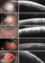 Image result for Scleritis