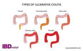 Ulcerative colitis symptoms can vary, depending on the severity of inflammation and where it occurs. What Is Ulcerative Colitis Uc Symptoms Treatment
