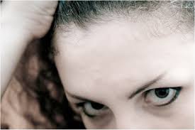 The copper iud can still alter the biochemical properties in our body and therefore can also influence our hormones in an indirect way, causing problems related to hormonal imbalance in women such as hair loss. Hair Loss From Mirena Iud Ways To Promote Regrowth Bellatory