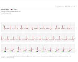 Normaler Puls Sinusrhythmus Smartphone Ekg Routinemessung Cardiopraxis