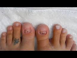 Nail Bed Prep For No Toenails Wear Update On Acrylic Toenails W Dual Forms Part 1 Youtube I think the transformation was pretty.