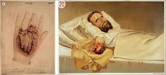References In Bromine Bear Claw Scratch Fasciotomies And The Eagle Effect Management Of Group A Streptococcal Necrotising Fasciitis And Its Association With Trauma The Lancet Infectious Diseases