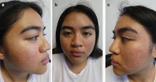 We did not find results for: Acne Vulgaris A Patient And Physician S Experience Springerlink