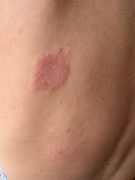 Image result for Eczema nummulare