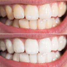 But not everyone still knows what it is. Zoom Advanced Teeth Whitening Treatments Lake Oswego Or