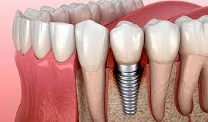 Can Periodontitis Otherwise Known As Gum Disease Affect Dental Implants