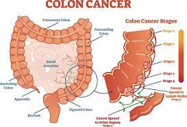 Colon cancer stages & survival rate. Colorectal Cancer Rates On The Rise In Younger People Health Scnow Com