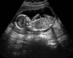 15 Semanas De Gravidez