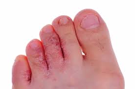 Image result for brown patches on the feet